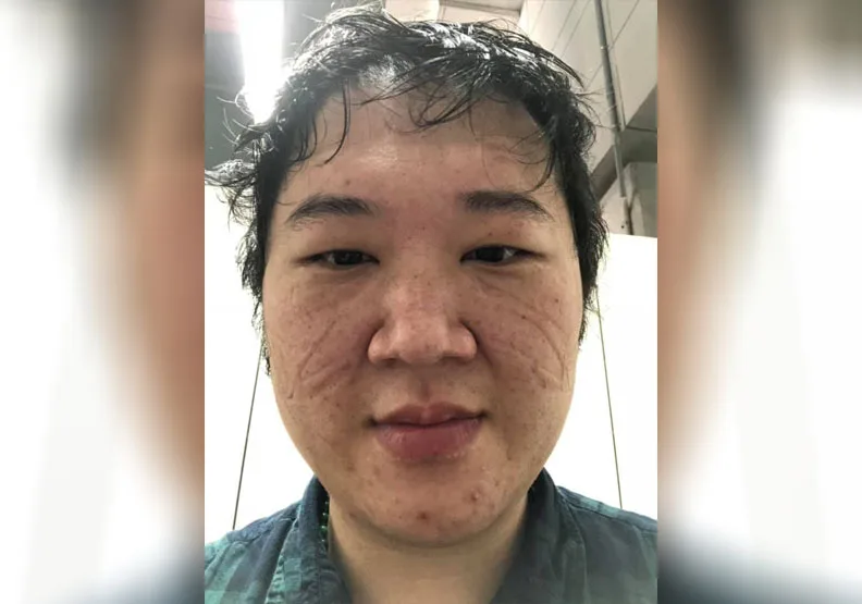 圖／台北市立聯合醫院胸腔科主治醫師鄒冠全在個人臉書貼出一張令人感動的自拍照。照片中的他從鼻樑到兩頰是深深的壓痕。鄒冠全提供